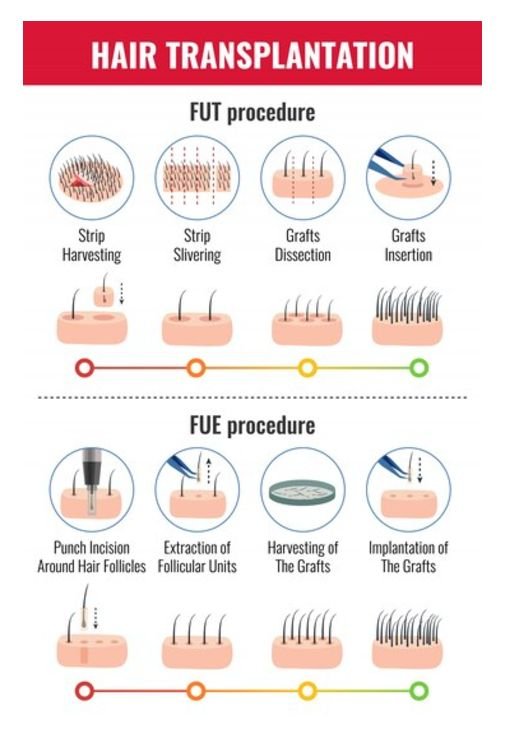 FUE vs FUT Which Hair Transplant 4
