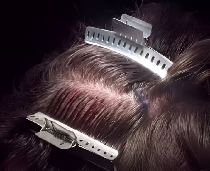 No Shave FUE Hair Transplant