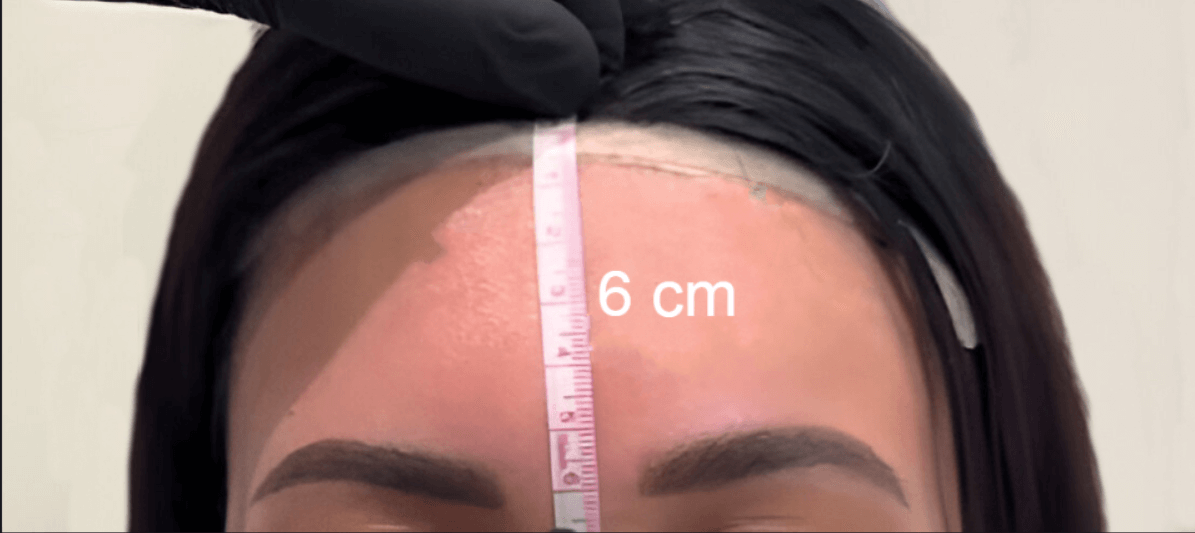 forehead hairlien lowering