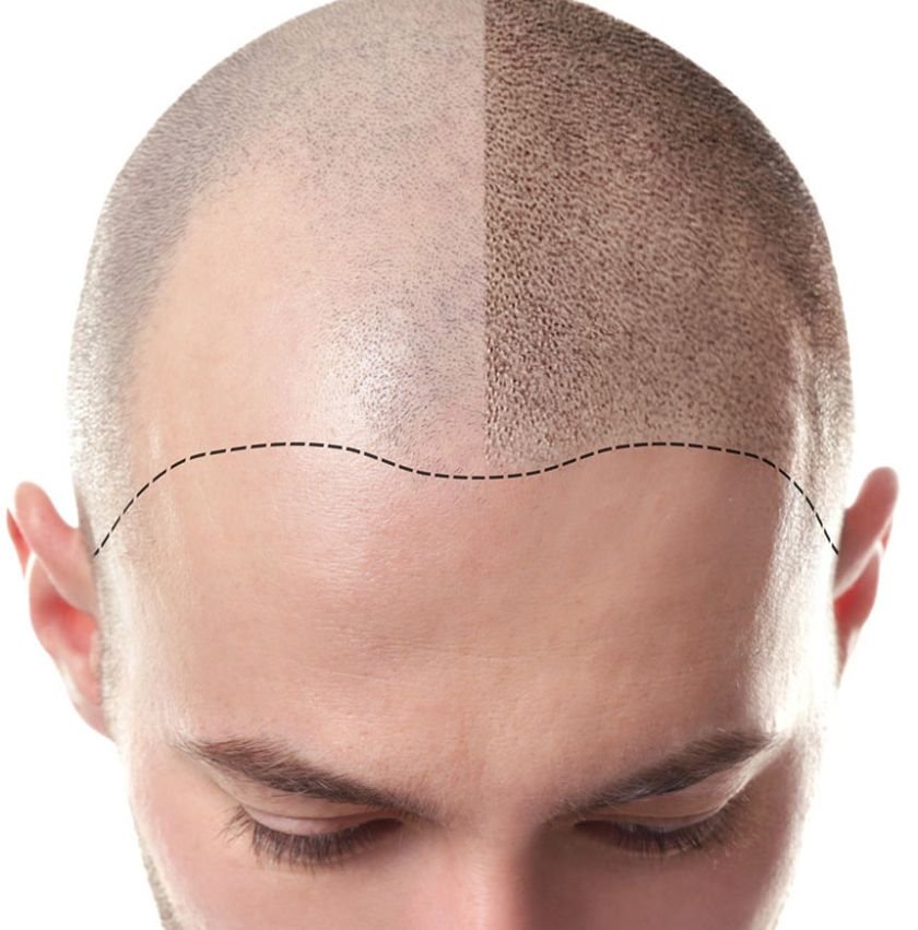 scalp micropigmentation